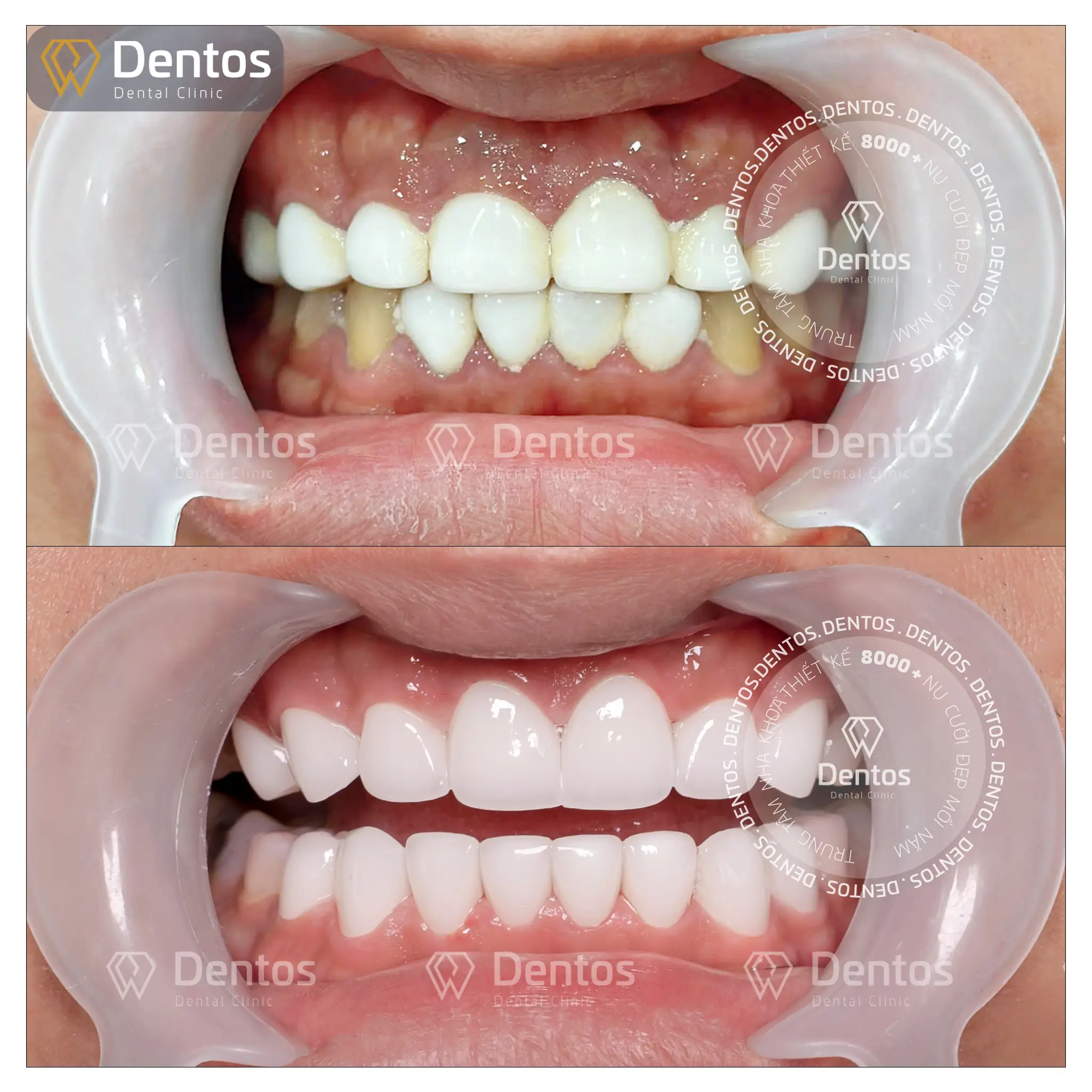 Không ít khách hàng đã phải đến Dentos khắc phục hậu quả phủ sứ nano